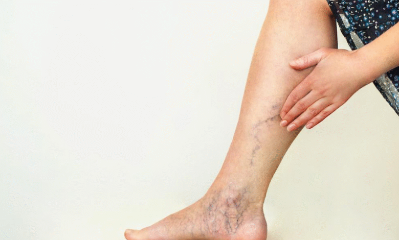 Artex Varicose